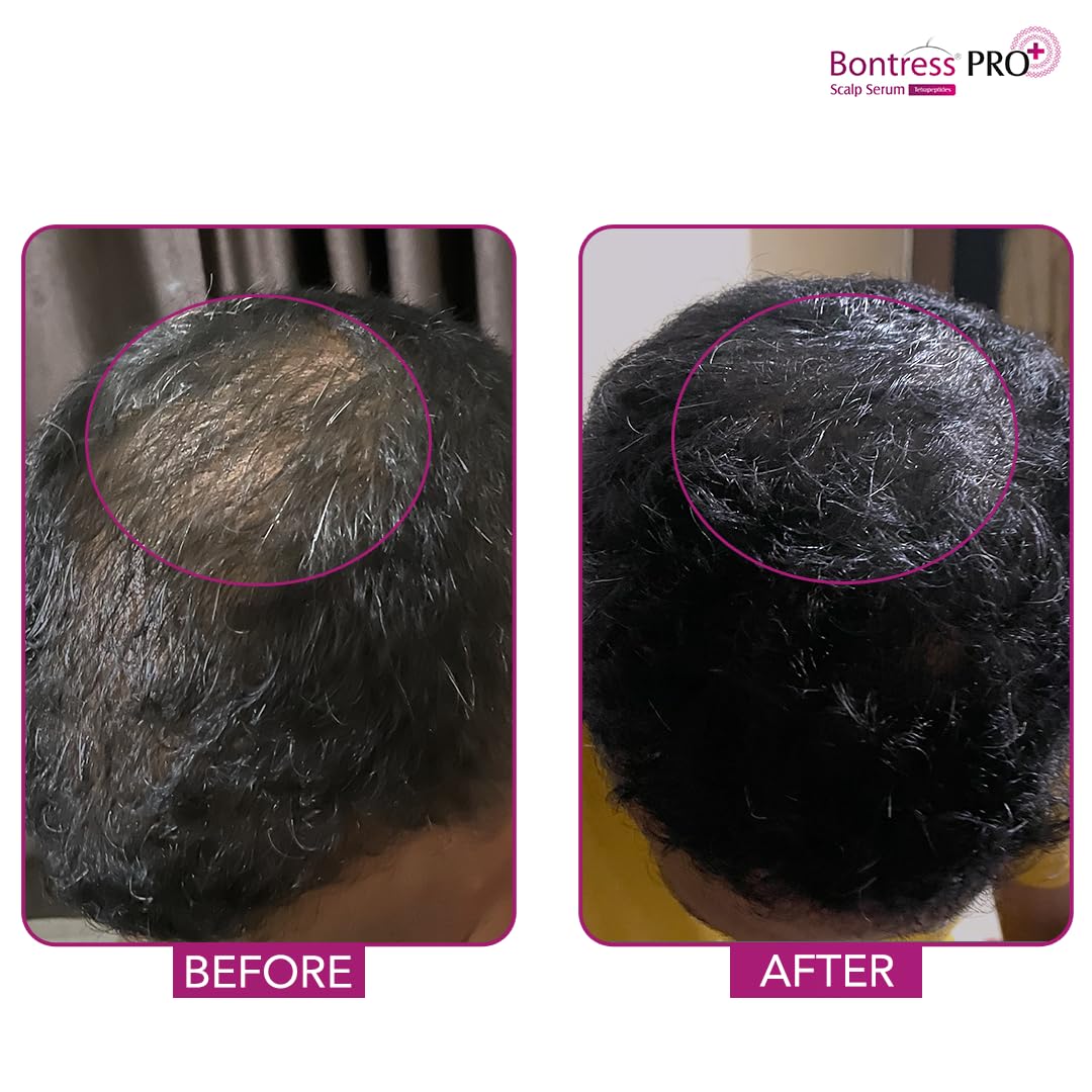Bontress PRO+ Scalp Serum Fortified with Redensyl, Anagain, Capixyl,Procapil | Hair Serum for Hair Growth & Hair Fall 30ml - Dhevu