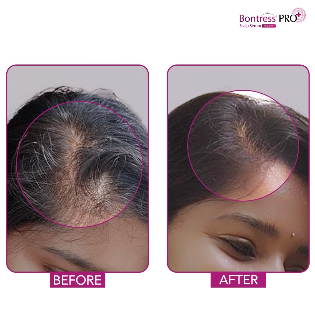 Bontress PRO+ Scalp Serum Fortified with Redensyl, Anagain, Capixyl,Procapil | Hair Serum for Hair Growth & Hair Fall 30ml - Dhevu