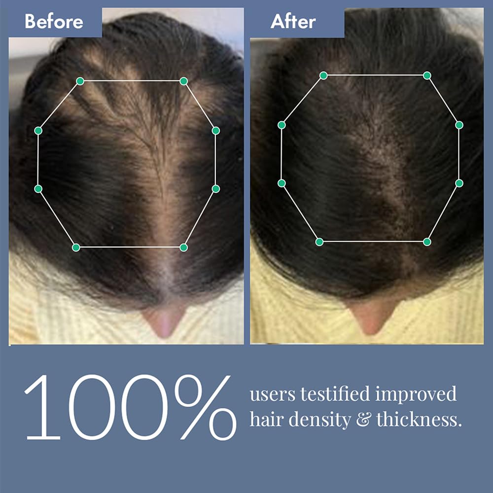 ThriveCo Hair Growth Serum 2.0,Clinically Proven To Reduce HairFall & Boost Hair Growth,Powered By Redensyl,Procapil & Anagain,Backed By British Medical Research,Lightweight,Non-Sticky,For Unisex 30Ml