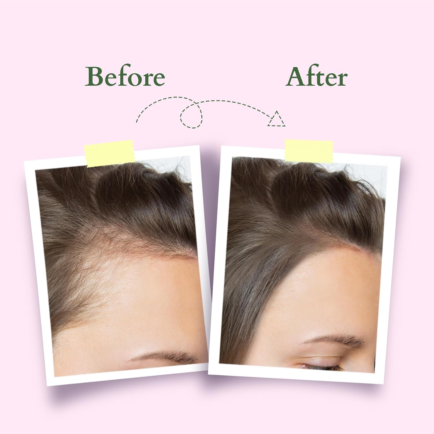 Lotus Organics+ Hair Growth Active Concentrate Serum | 100% Organic Rosemary Oil, AnaGain & Hairdian| 28ml - Dhevu