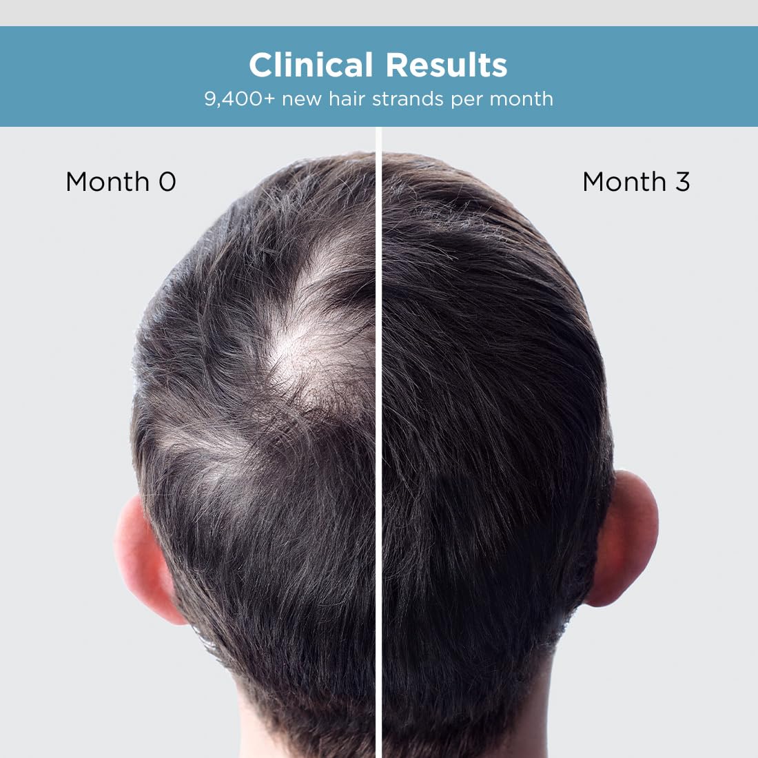 The Man Company Hair Growth Serum for Men (30ml) with 3% Redensyl, 4% Anagain, 3% Biacapil | Stimulates Hair Growth | Prevents Hair Fall | Improves Hair Strength