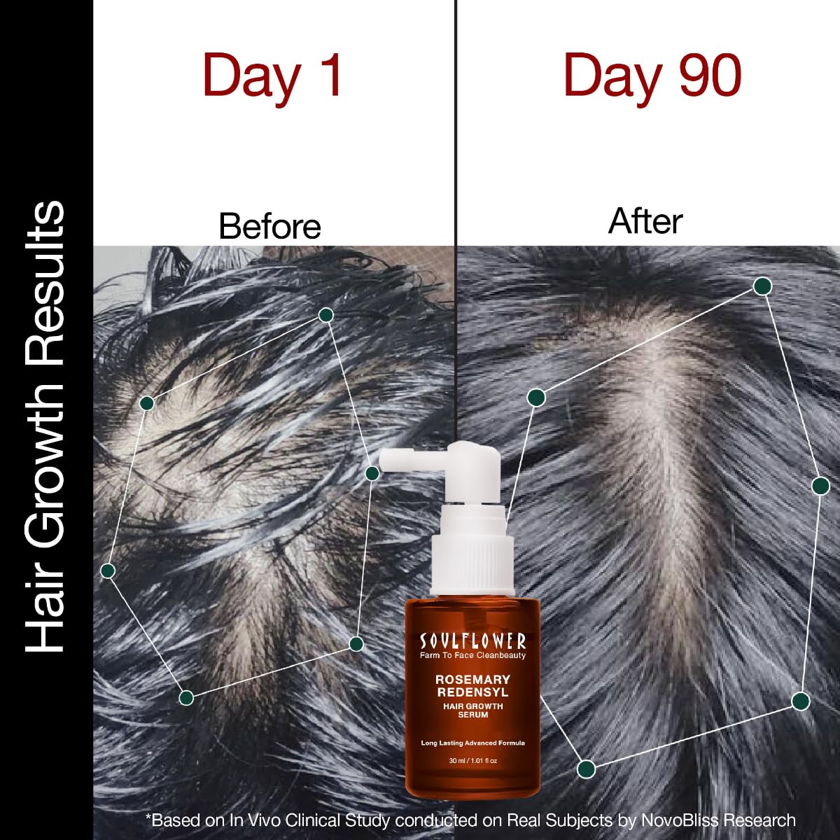Soulflower Hair Growth Serum, Rosemary Oil, 3% Redensyl, 4% Anagain, Caffeine, Melanogray, Biotin, Rice Water, Clinically Tested on Real people, Hair growth & Hair fall control for Women & Men | 30ml