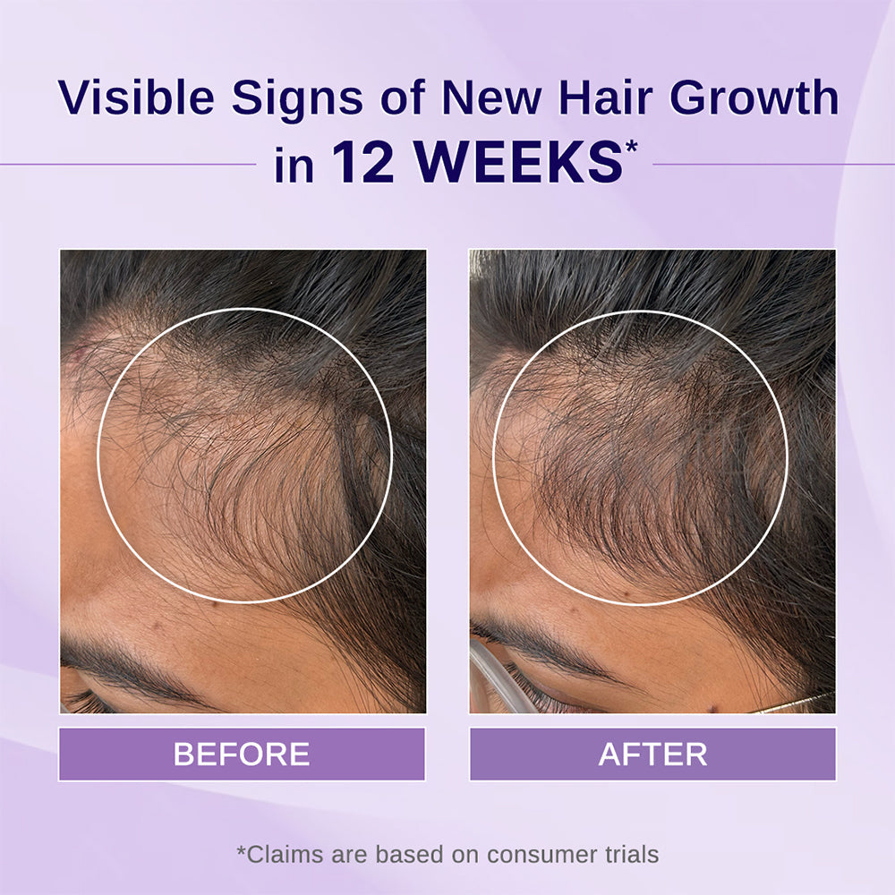 Bare Anatomy Rosemary & Hibiscus Hair Growth Oil 100Ml